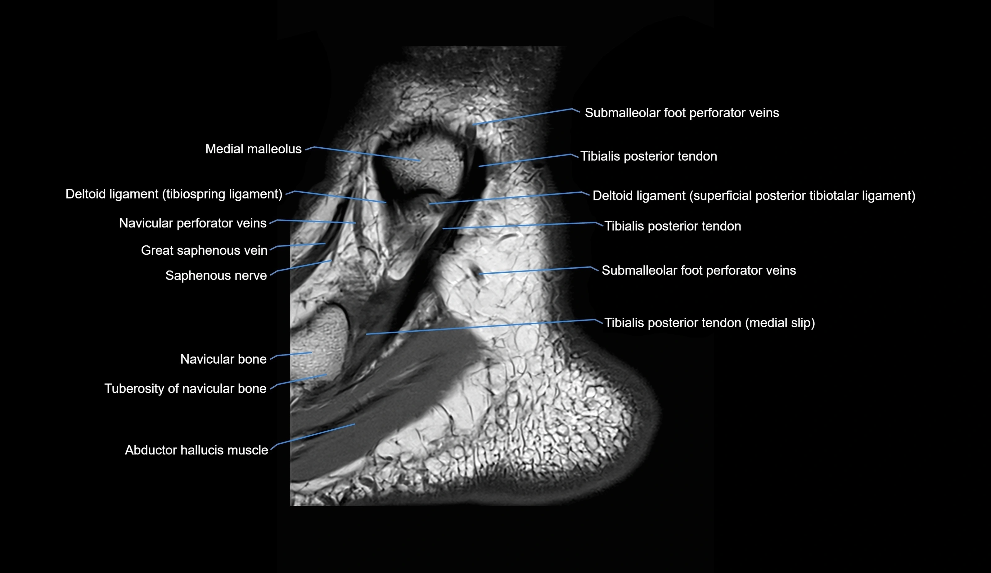 MRI Ankle sagittal cross sectional anatomy 3T  radiology  image-img-00001-00004.webp